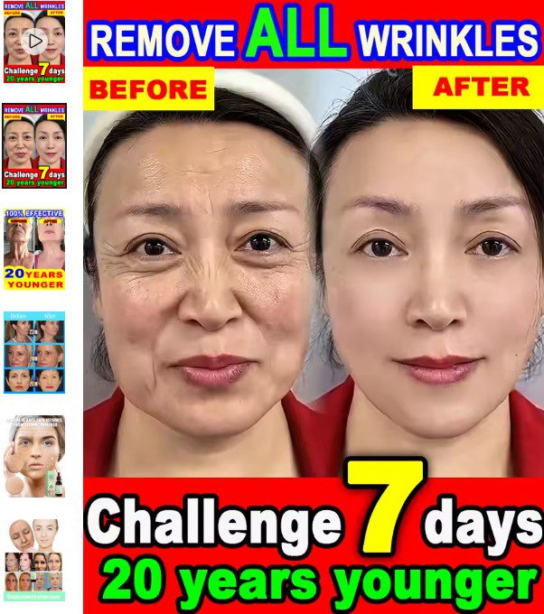Wrinkles disappear,20 years younger